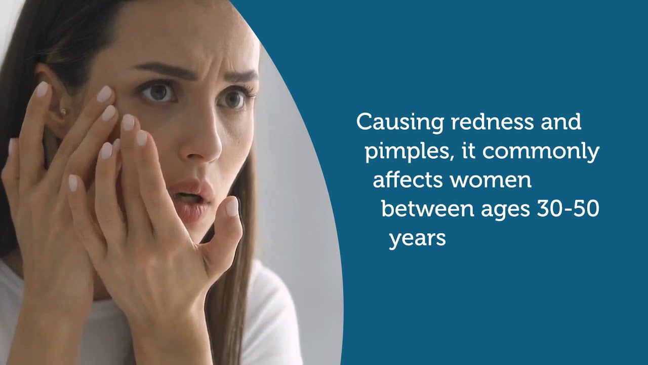 Treating Rosacea: How Analyzing Your Genetic Variants Can Help