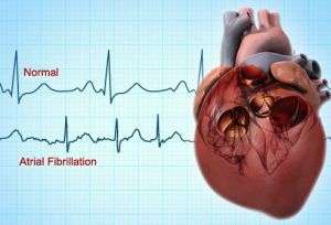 webmd_rf_photo_of_atrial_fibrillation