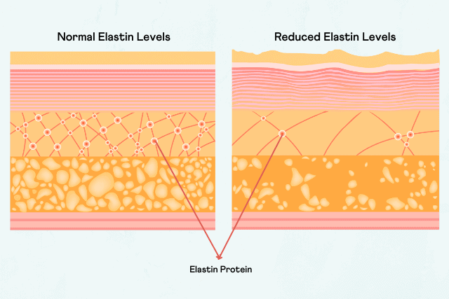 How It Works: Stretch Marks And Genetics