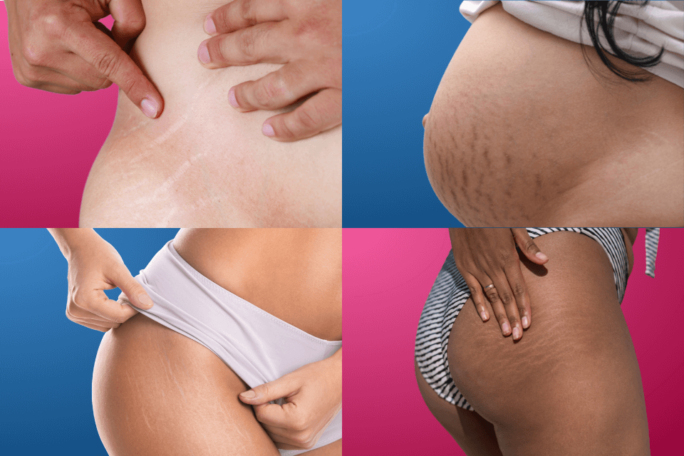Why Do I Have Stretch Marks But Am Skinny? - Simi Doctors - Blog