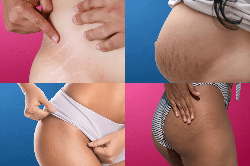 Are stretch marks genetic? Four images of stretch marks: 1. Side lower hip 2. Lower abdomen due to pregnancy 3. Thighs 4. Buttocks