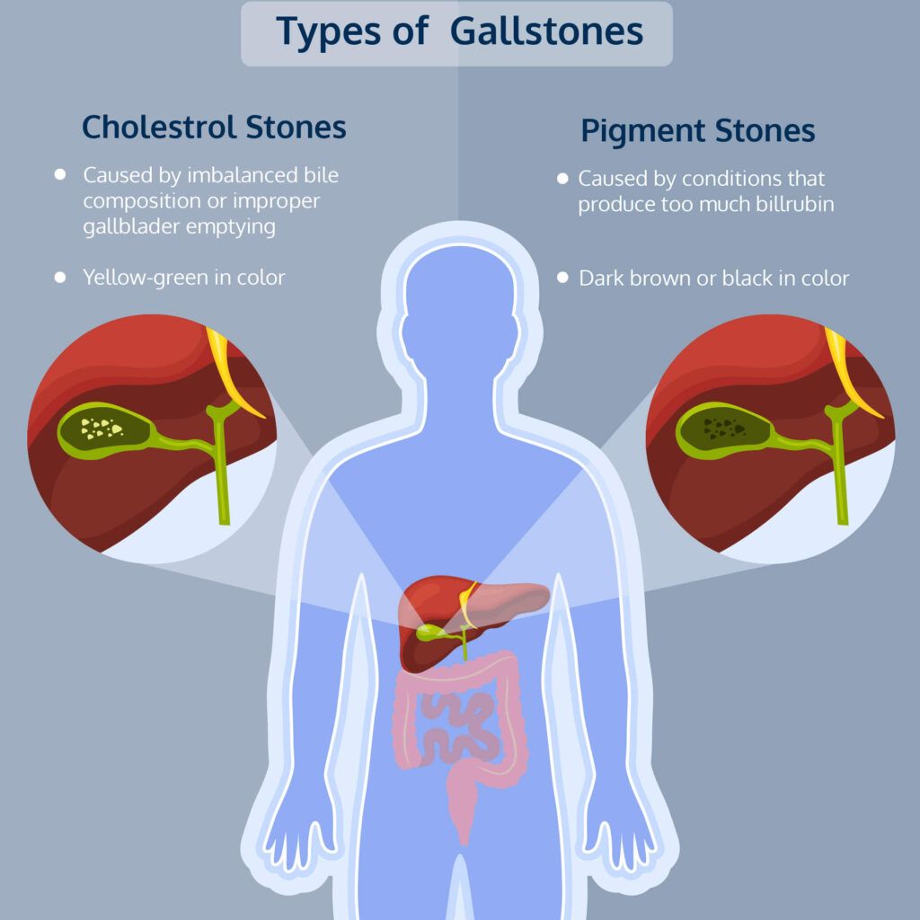 Image: Are Gallstones Hereditary? Types of Gallstones
