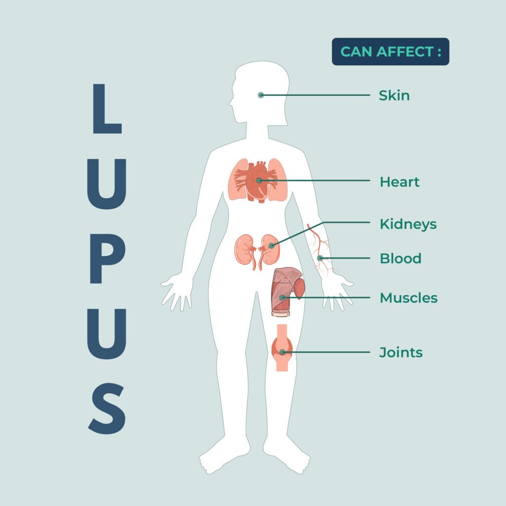 Is lupus hereditary