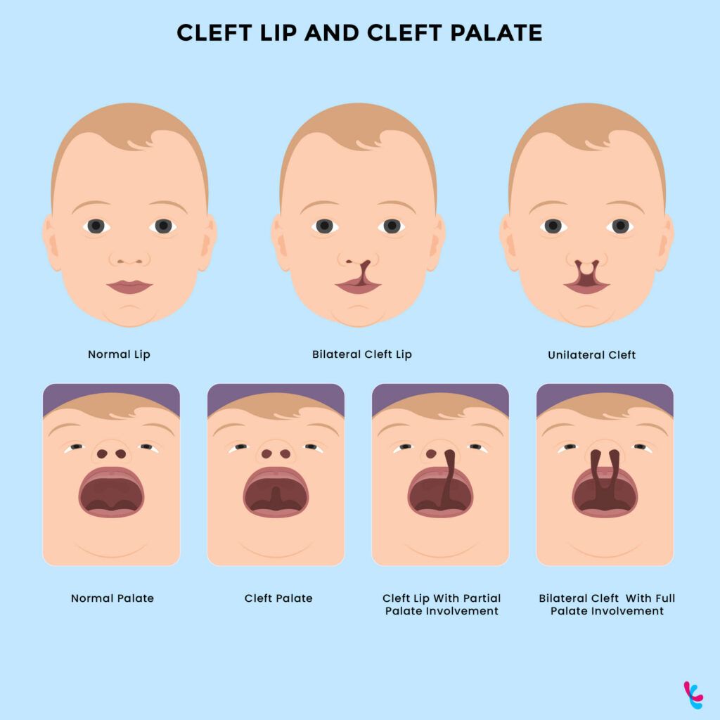 Is Cleft Lip Genetic? Cleft lip and palate (CLCP) can affect one side of the face (unilateral) or both (bilateral). The image depicts different types of CLCP cases.