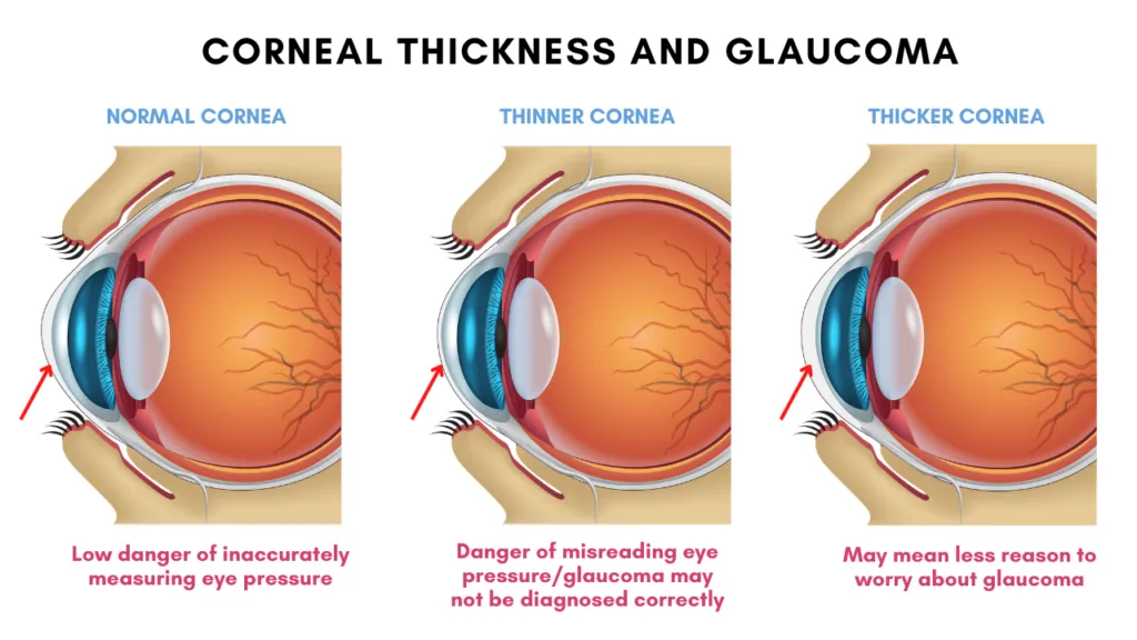 Corneal Thickness and Glaucoma: Corneal thickness can influence the measurement of eye pressure, which is important to diagnose glaucoma. A thin cornea can lead to an lead to a lower measurement of eye pressure, leading to the masking of potential glaucoma. A thick cornea leads to an increased measurement of eye pressure, but this may not indicate a glaucoma diagmosis.