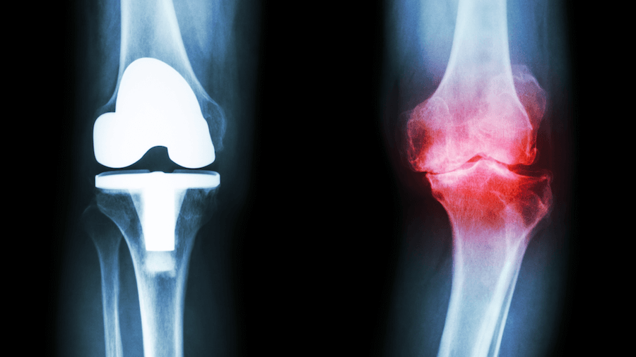 X-ray image showing a normal knee joint on the left and knee joint affected by osteoarthritis on the right