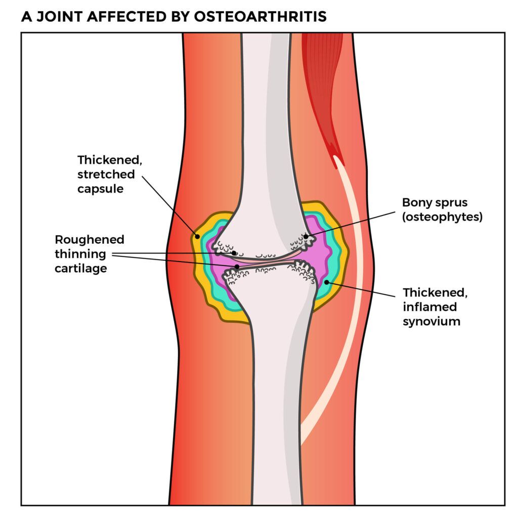 Diagram depicting the anatomy of a joint affected by osteoarthritis