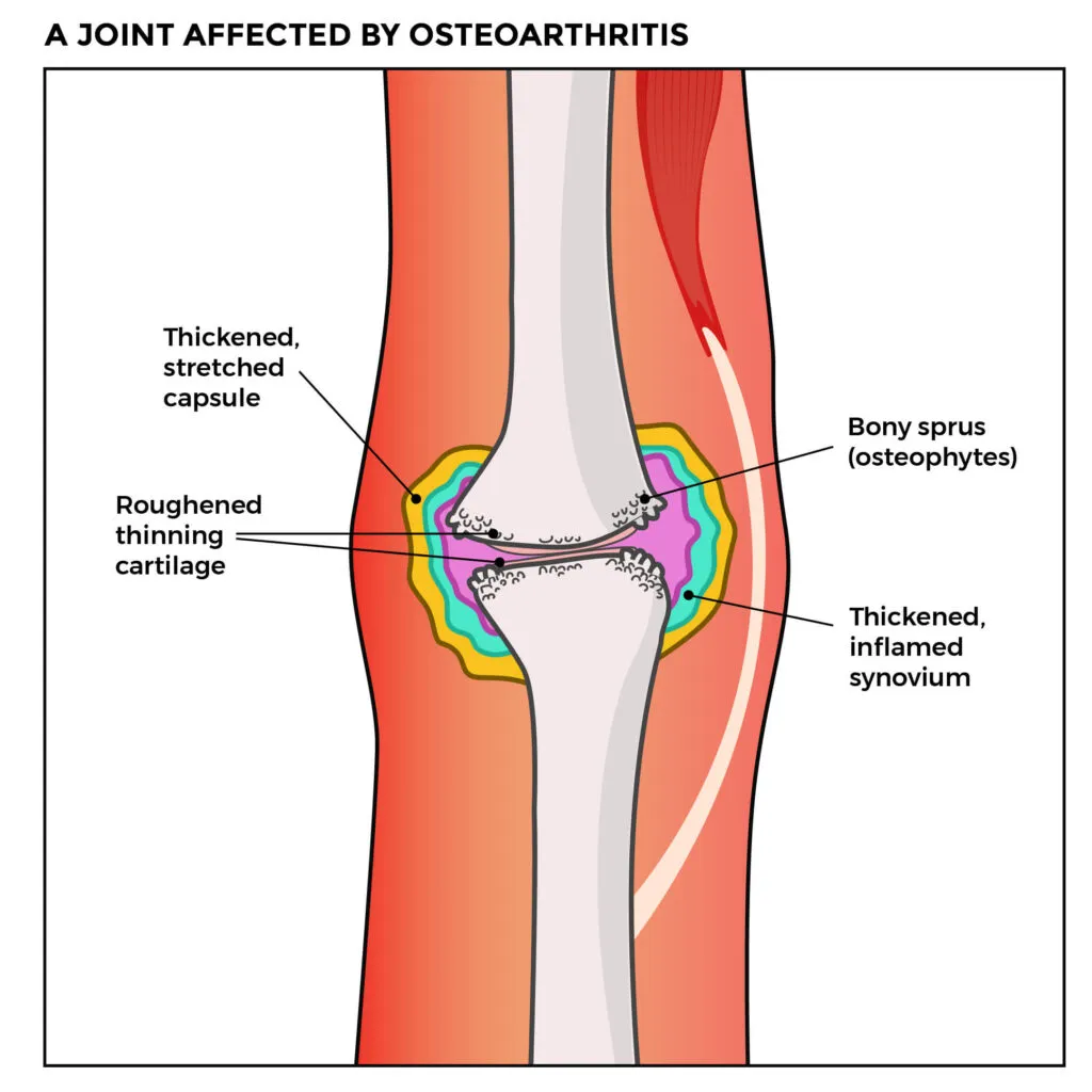 Diagram depicting the anatomy of a joint affected by osteoarthritis