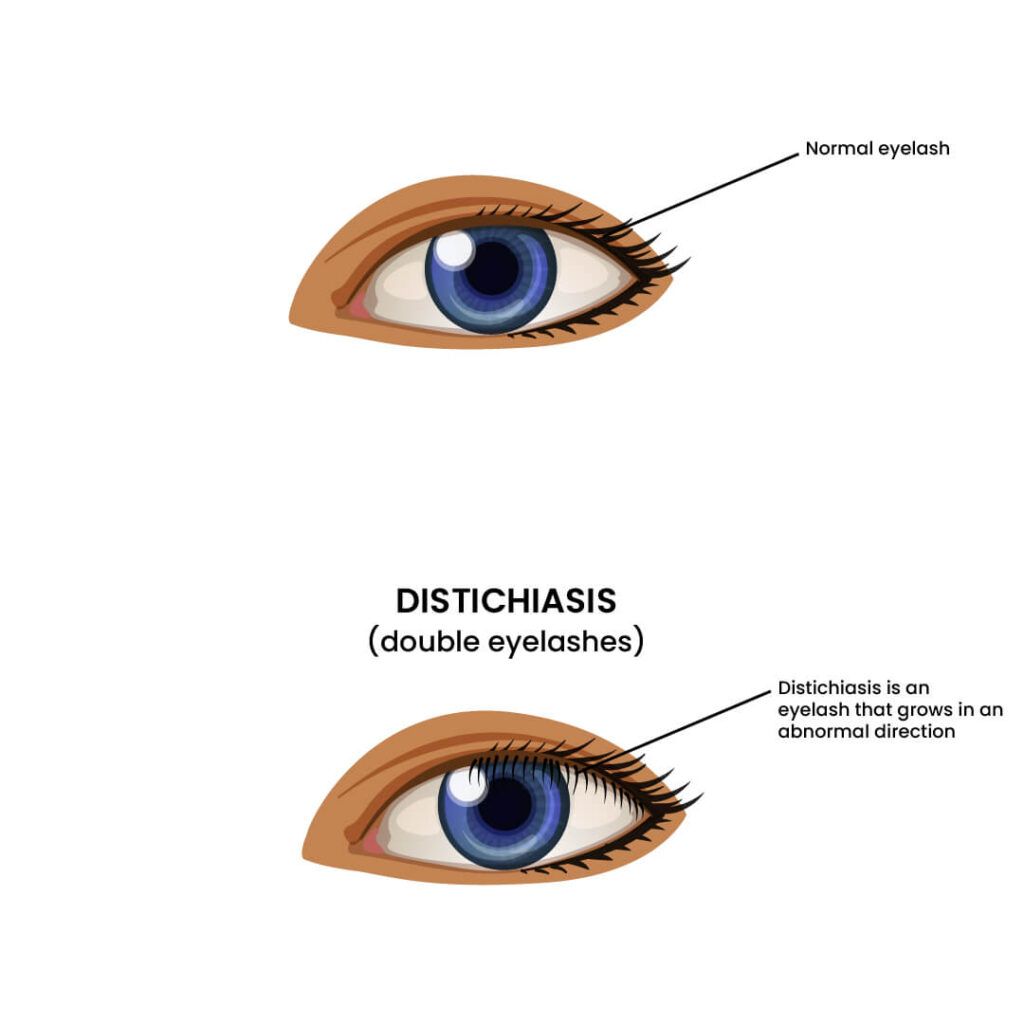 Image showing a caricature of double eyelashes a genetic anomaly