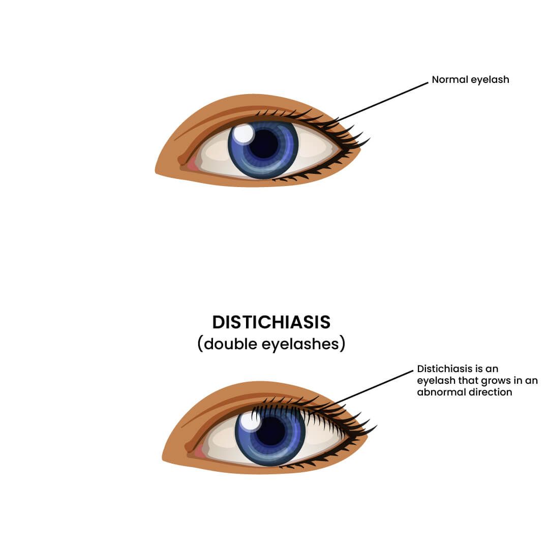 Distichiasis Double Eyelashes Vs Normal