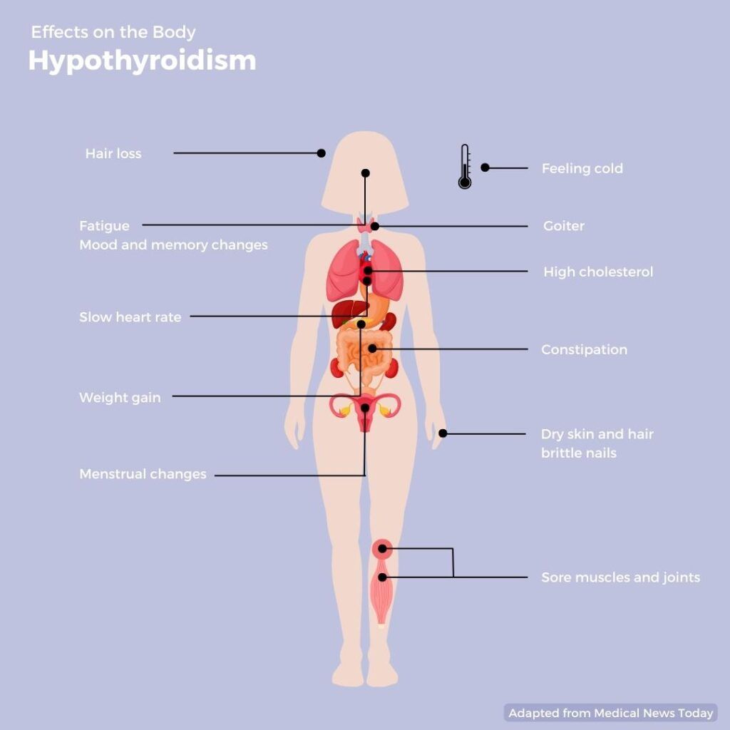 Infographic of the human body describing the effects of hypothyroidism