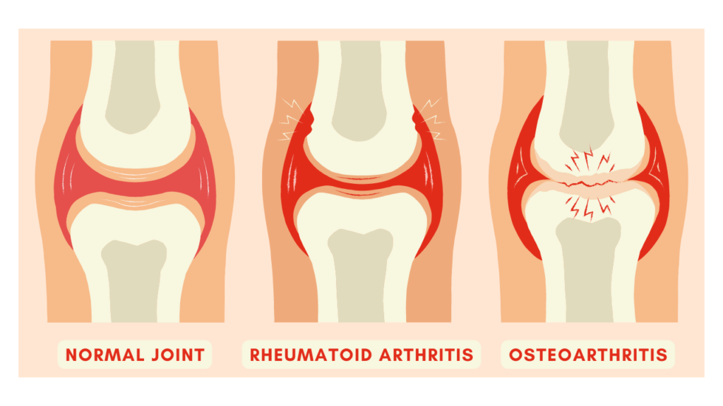 Image showing joints with arthritis