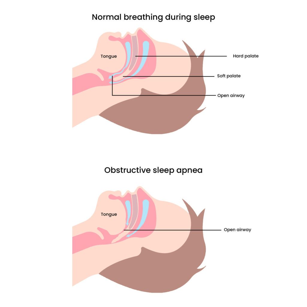 Sleep Apnea and Brain Damage: The differences in air pathway during breathing with and without sleep apnea