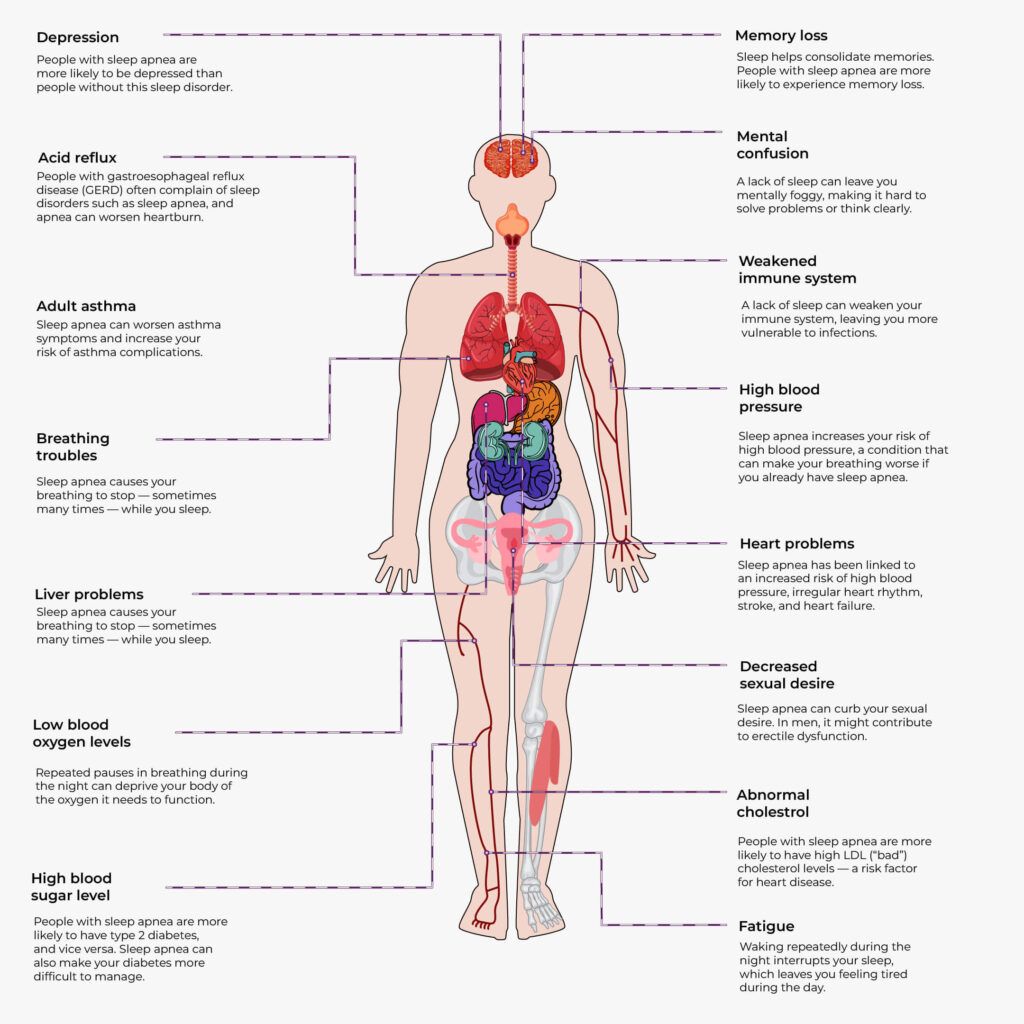 Side effects of obstructive sleep apnea