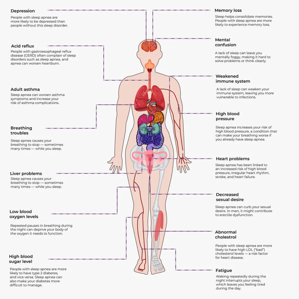 Side effects of obstructive sleep apnea