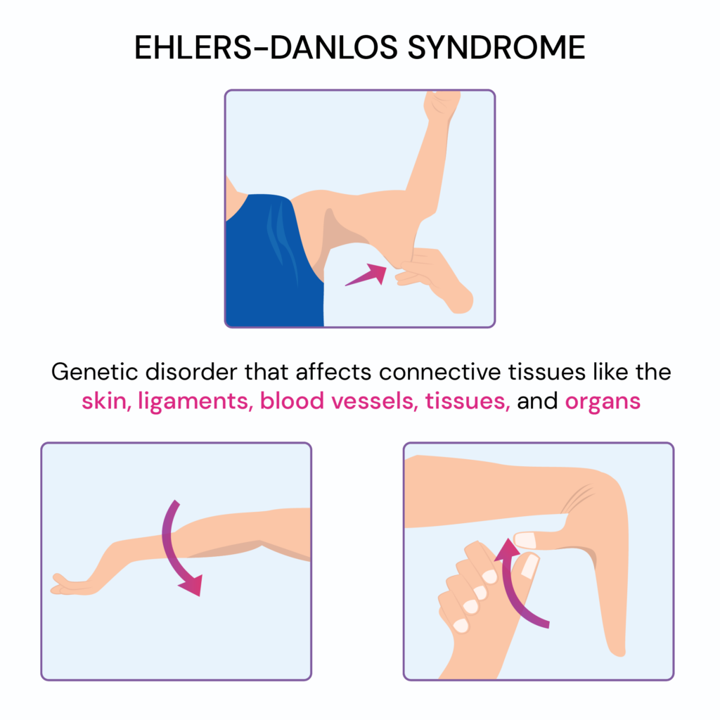 23 Signs You Grew Up With Ehlersdanlos Syndrome [2023]