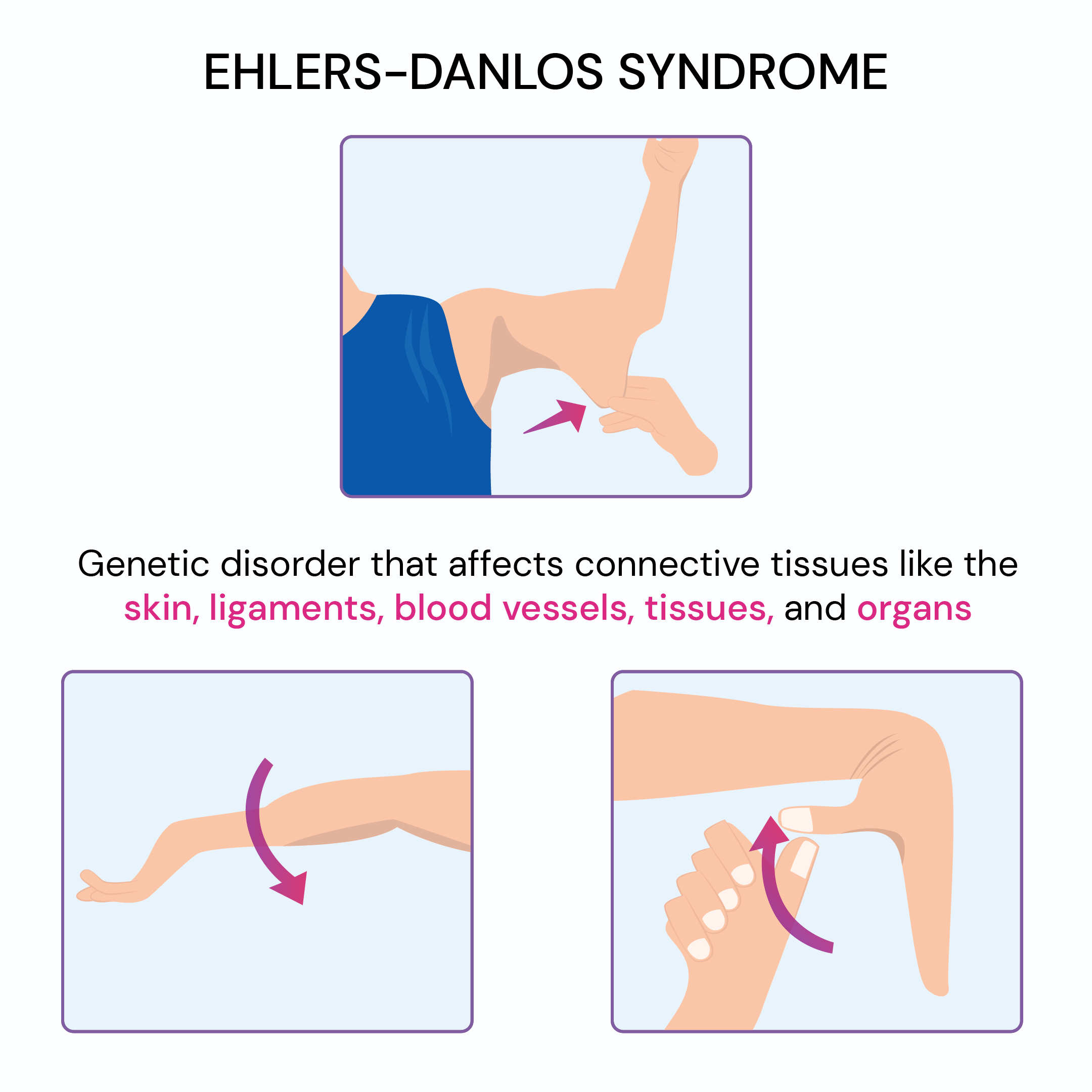 23 Signs You Grew Up With Ehlers-danlos Syndrome [2023]