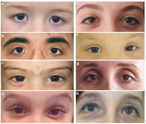 Effect of Ehlers Danlos syndrome on the eyes