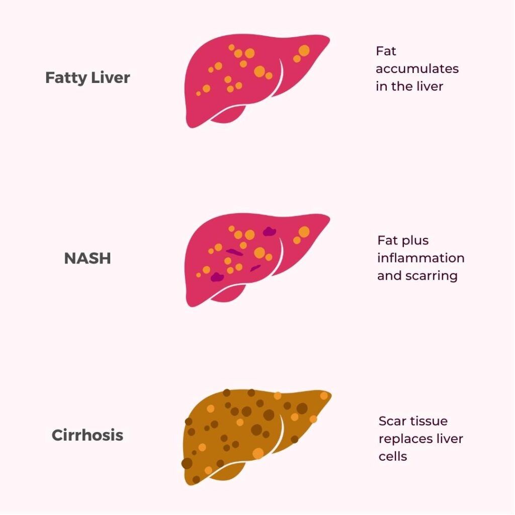 Infographic showing different forms of liver cirrhosis
