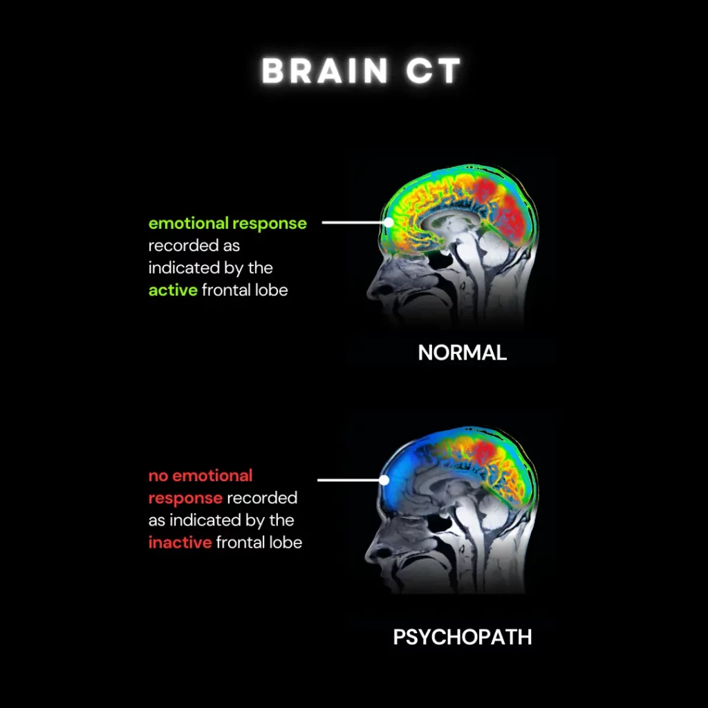 CT images of 2 brain - the top one is that of a normal person and the bottom one is that of a person with psychopathy. In the "normal" brain that frontal lobe is lit up, indicating an active emotional response. In contrast, in the "psychopath" brain there is no emotional response seen.