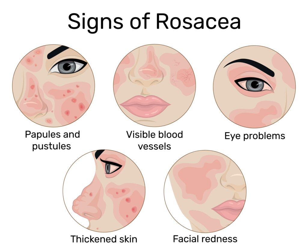 Infographic showing the signs of developing rosacea