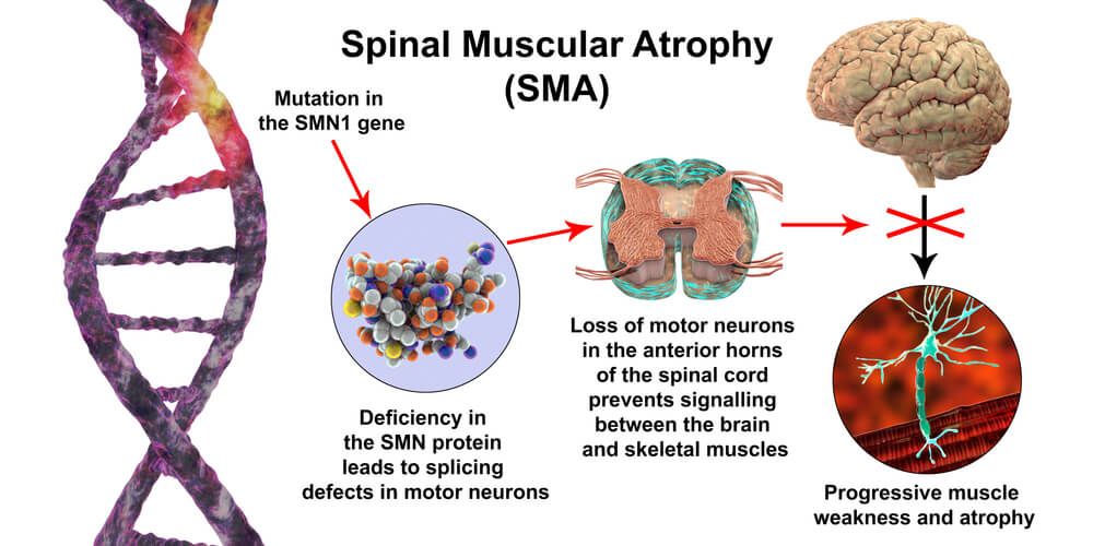 Image showing the detail science of spinal muscular atrophy