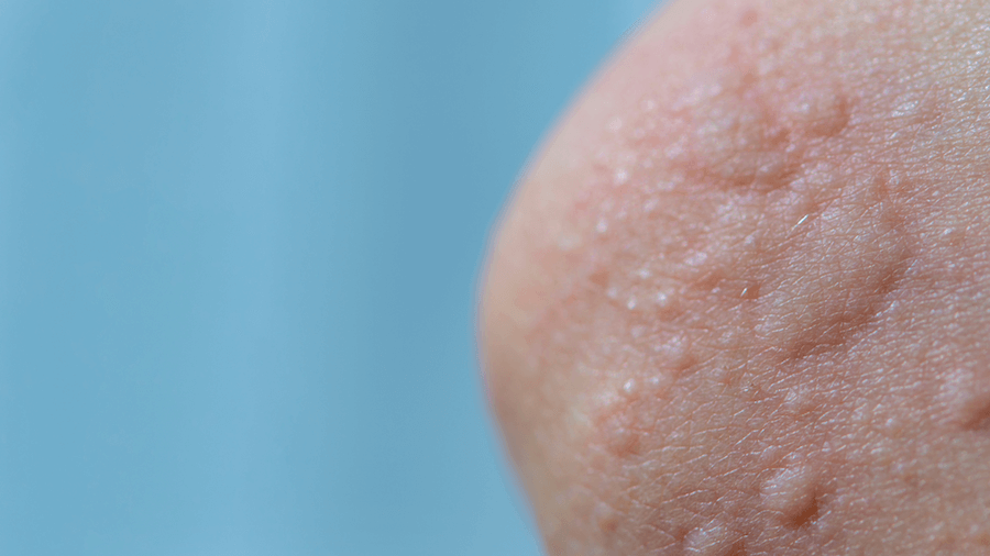 Excess Vitamin B12 And Histamine Intolerance A Genetic Link