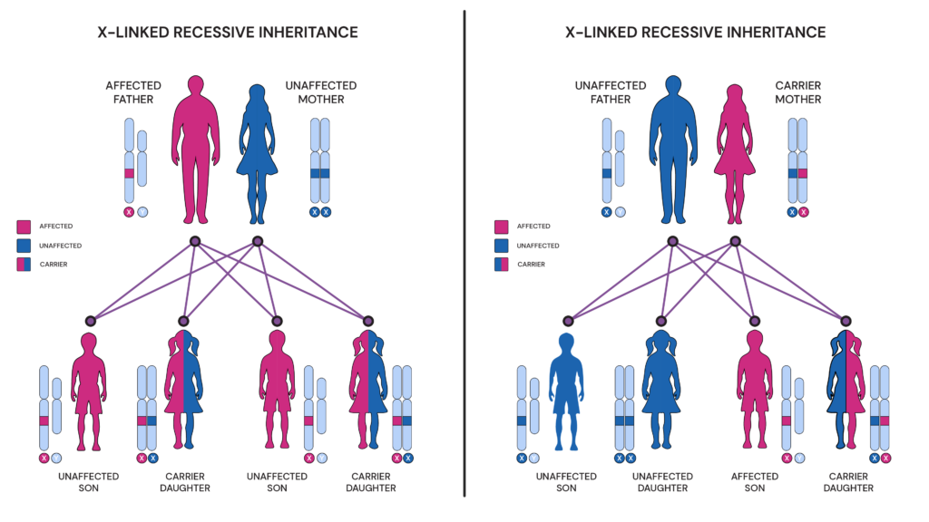 Hemophilia is caused by mutations in the genes that provide instructions for making proteins necessary for blood clotting, which are located on the X chromosome. As a result, hemophilia is more commonly inherited by males than females since males have only one X chromosome. Females who inherit a mutated hemophilia gene may still have a normal copy of the gene on their other X chromosome, which can compensate for the mutation. Carriers of the hemophilia gene mutation typically do not experience symptoms themselves, but they can pass the mutated gene on to their children. 