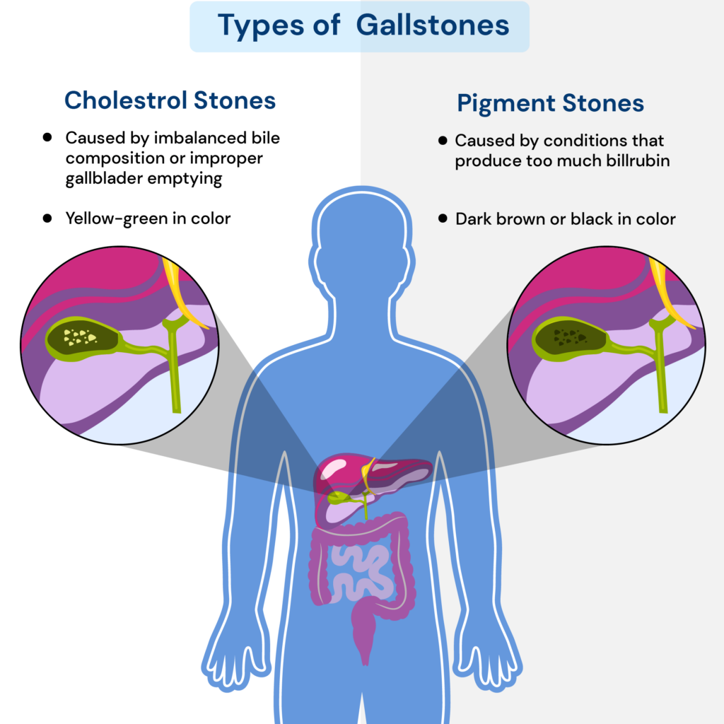 Infographic showing the different types of gallstones caused due to stress.