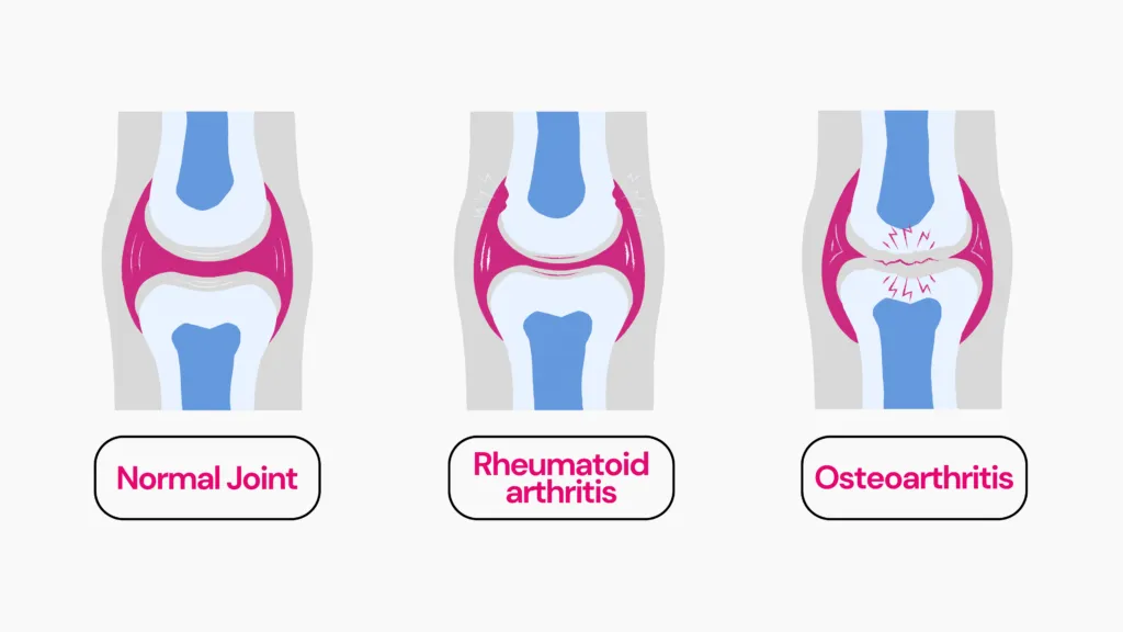 Image showing joints with arthritis