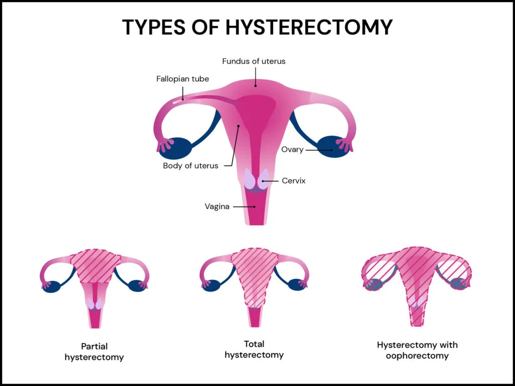 Infographic showing the different types of hysterectomy