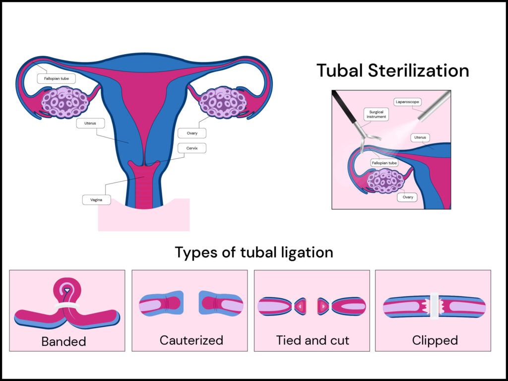 Infographic showing the types of tubal ligation