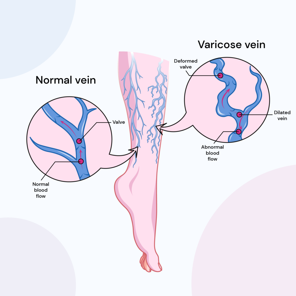 Diagram showing the formation of varicose veins in the legs