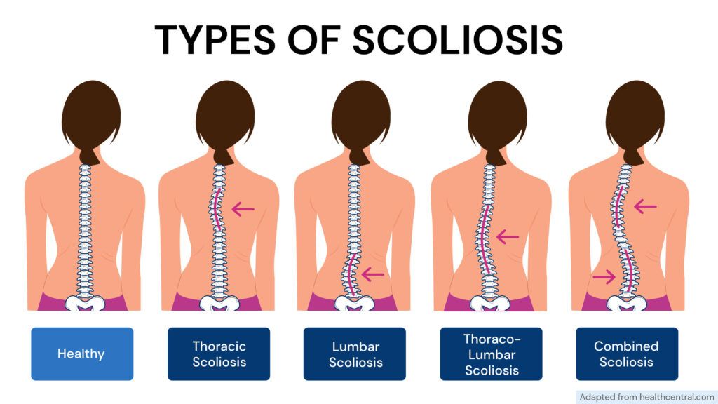 Is Scoliosis Genetic? The image displays 5 different types of scoliosis, each with a slightly different spinal curvature. For comparison purposes, a normal spine is also shown.