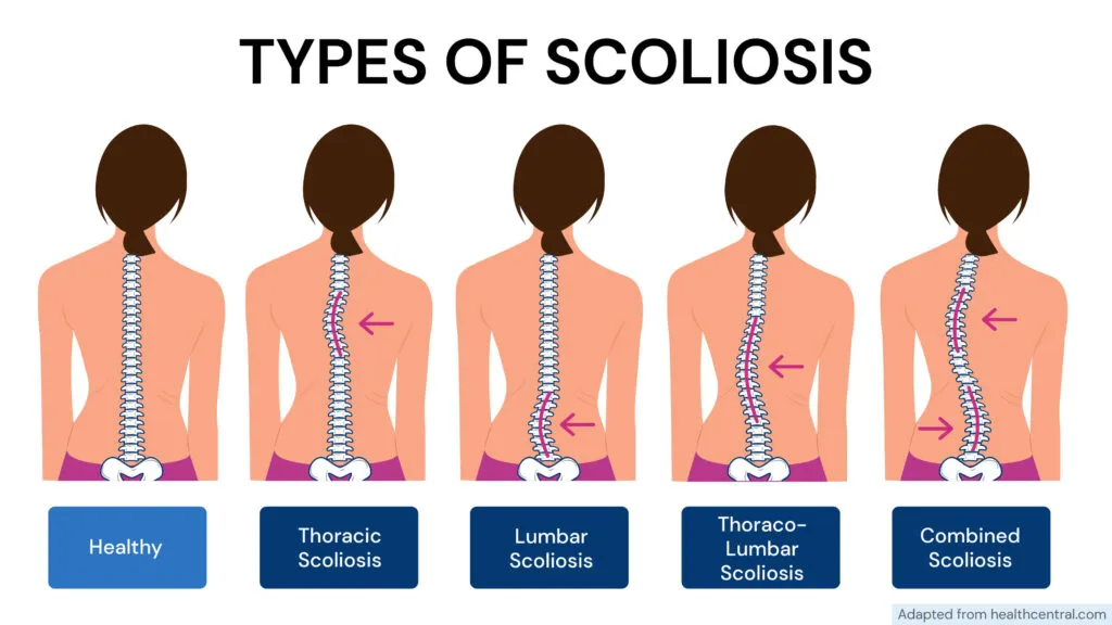 Is Scoliosis Genetic? The image displays 5 different types of scoliosis, each with a slightly different spinal curvature. For comparison purposes, a normal spine is also shown.