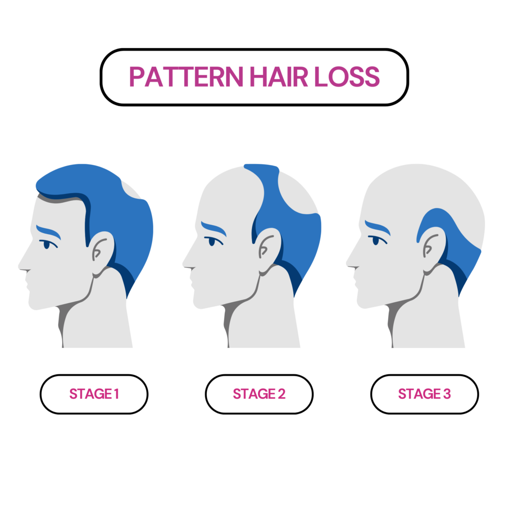 Infographic showing the different stages of pattern hair loss.