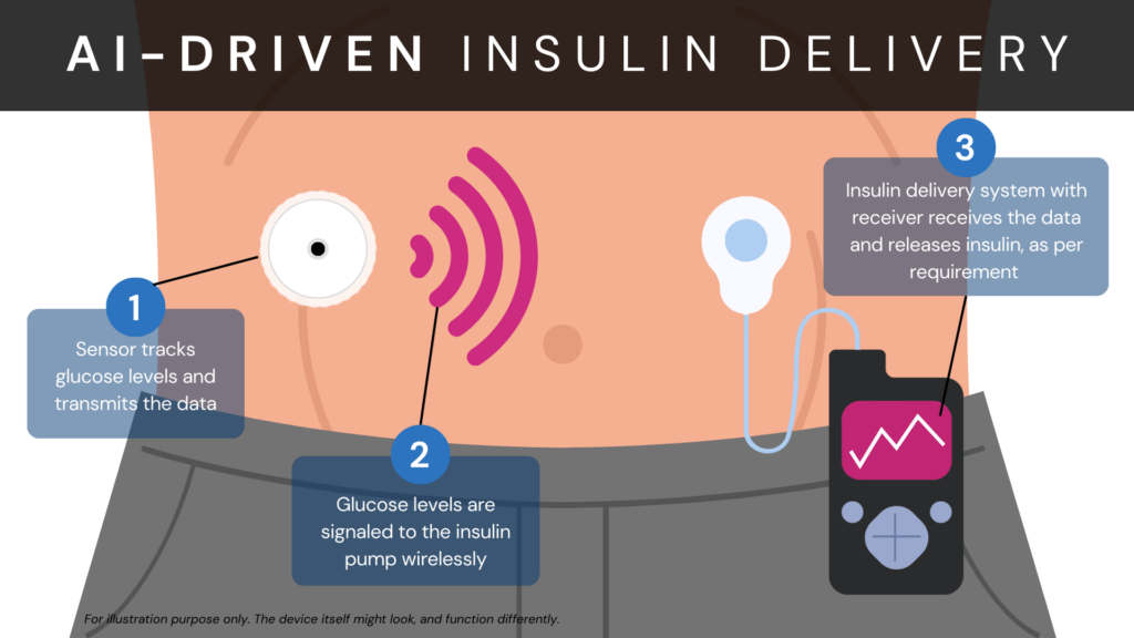 AI Diabetes: This image summarizes how AI is used to automate insulin delivery. It shows a glucose level monitoring device attached to a person's abdomen. Next to it as an icon representing data transmission of glucose levels from the monitor to the receiver. The receiver is shown to be attached to the person's pants. Along with a receiver is a insulin deliver port, which upon reading the glucose levels, releases insulin into the body, if required.