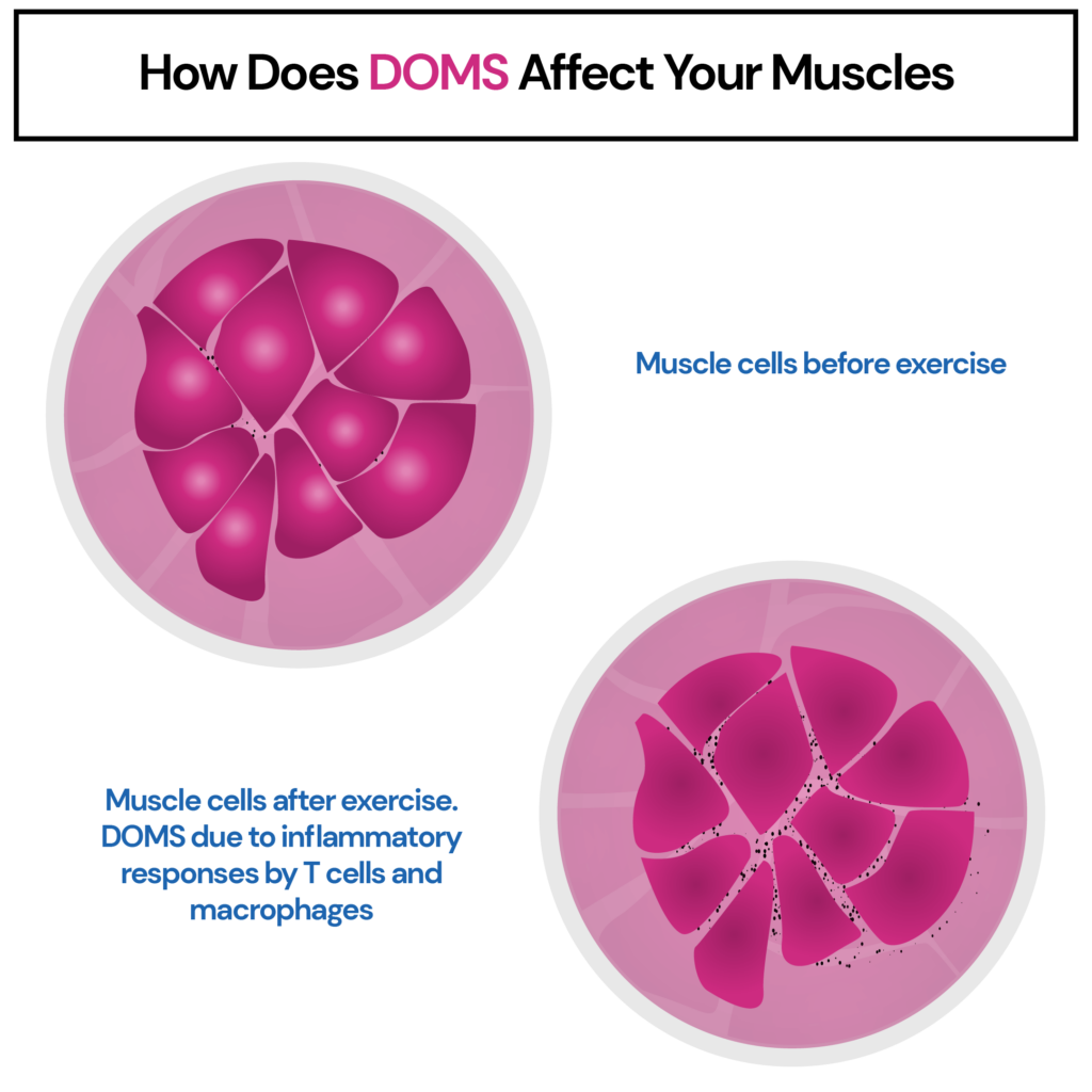 Is DOMS A Sign Of Muscle Growth? The image shows the inflammatory responses in muscles due to DOMS.