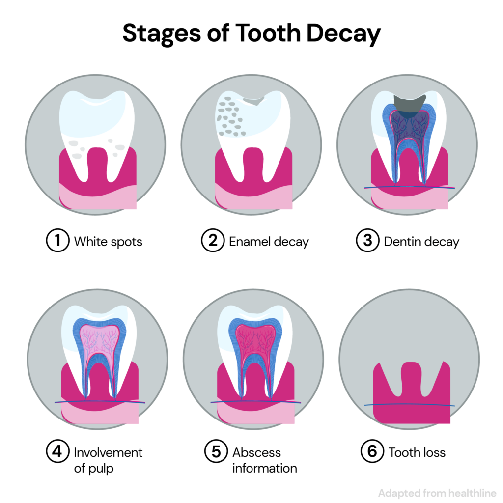 Are Cavities Genetic? Image depicting the effects of different stages of decay on the tooth. 