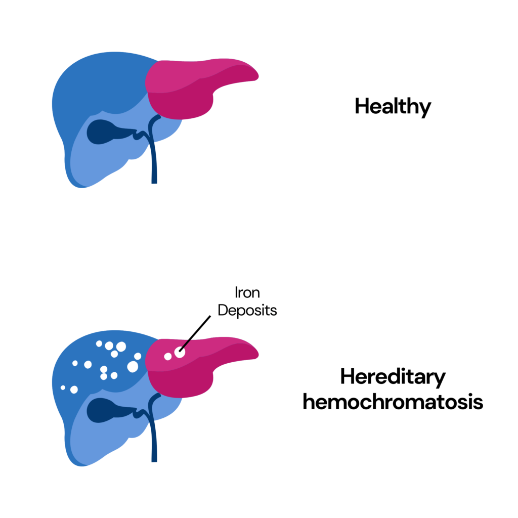 Image showing hereditary hemochromatosis
