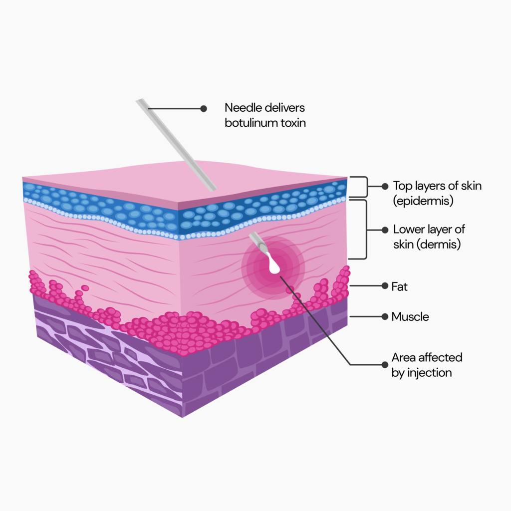 Botox for hair loss:  This picture depicts the layers of the skin where the top layer of the skin is called the epidermis, the underlying lower layer is called the dermis, followed by fat and muscles. A needle is inserted into the skin, which delivers the botulinum toxin to the lower layer of the skin called the dermis.