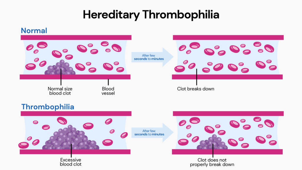 Hereditary Thrombophilia: This image depicts a typical blood vessel where the normal size blood clot breaks down after a few seconds to minutes, whereas thrombophilia cases do not properly break down, resulting in restrained blood flow.