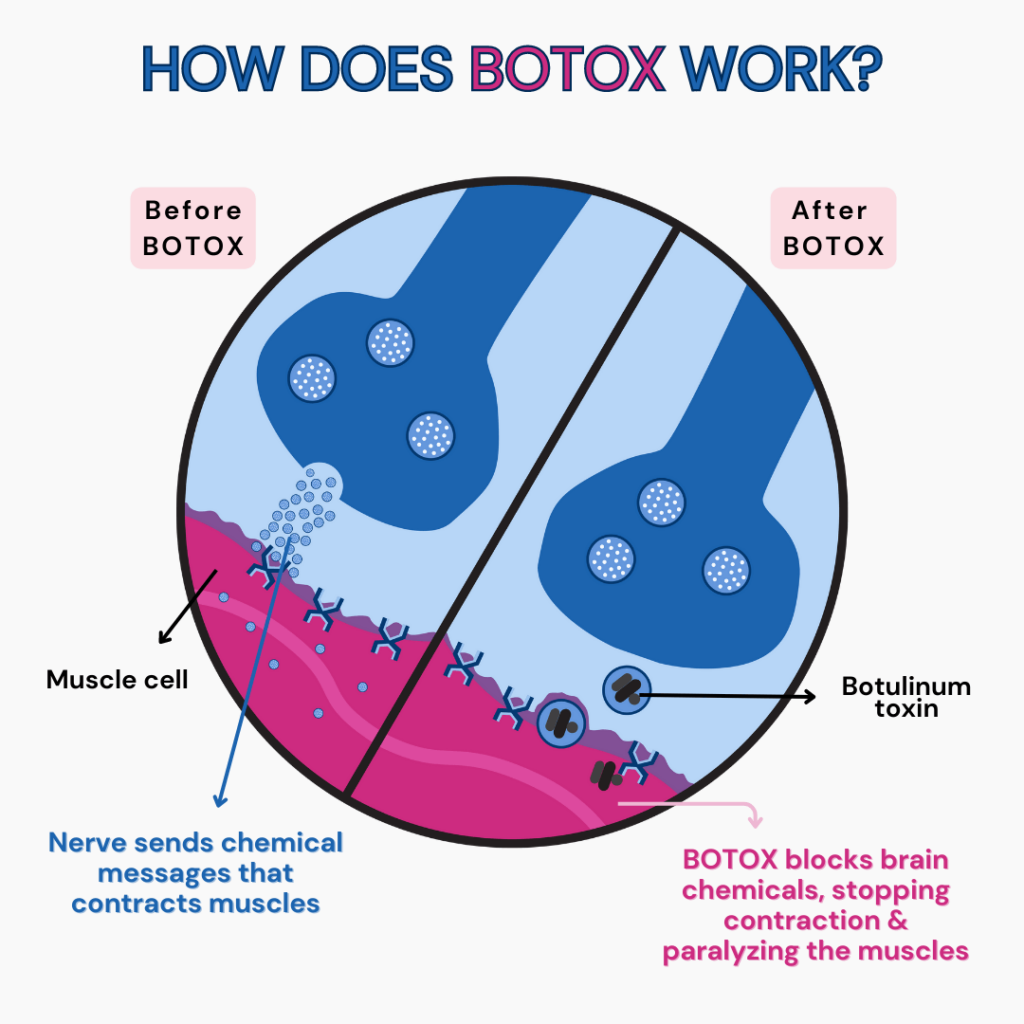 An illustration explaining how botox works. Shows a comparison of how normally brain chemicals help muscle contract vs how botox stops these chemicals and paralyzes the muscles at the site of injection. 