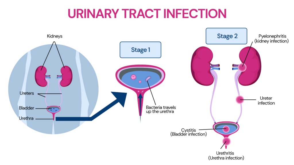 An image explaining the different stages of UTIs. Stage 1 shows bacteria in the bladder and stage 2 shows infection in bladder, ureters, and kidneys