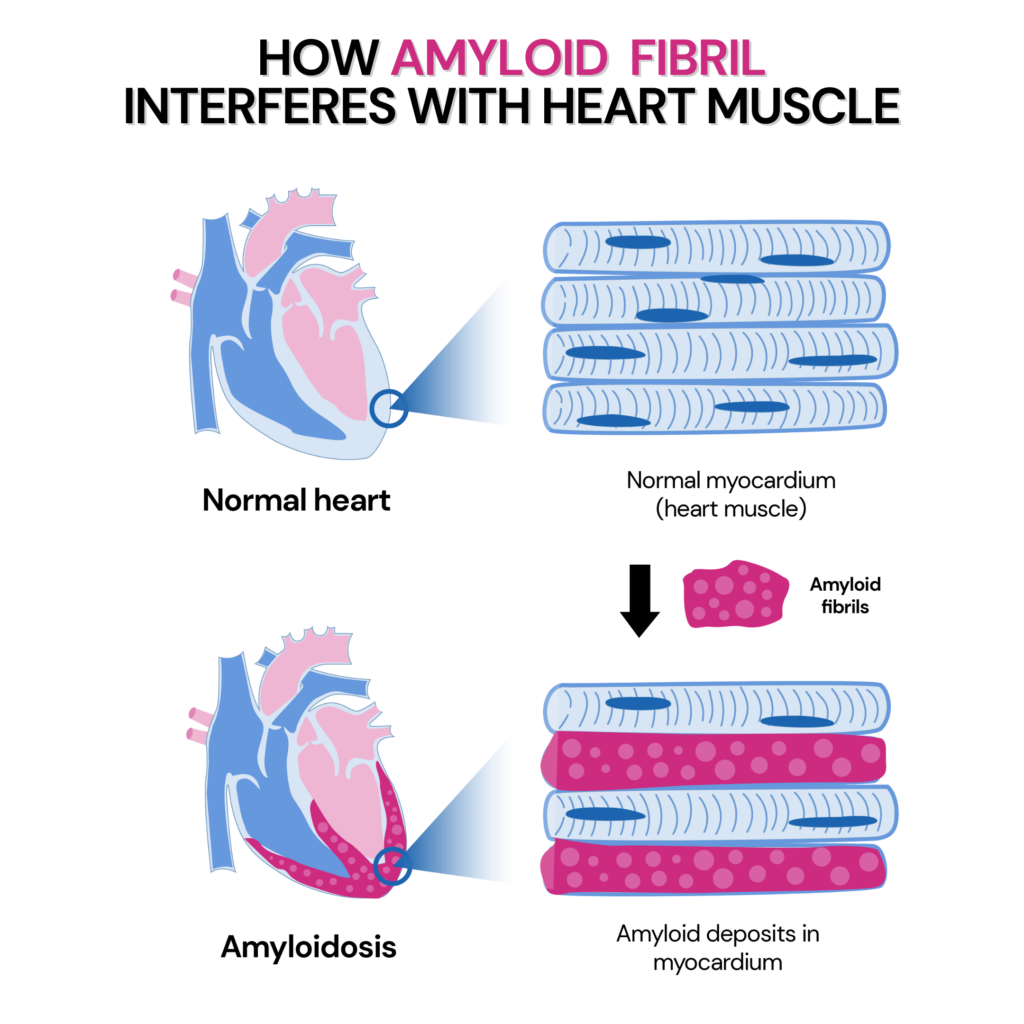 hereditary amyloidosis - infographic explaining how amyloid fibril interferes with heart muscle. Two sections depict a normal heart muscle called the myocardium and the amyloid deposits within the heart muscle.