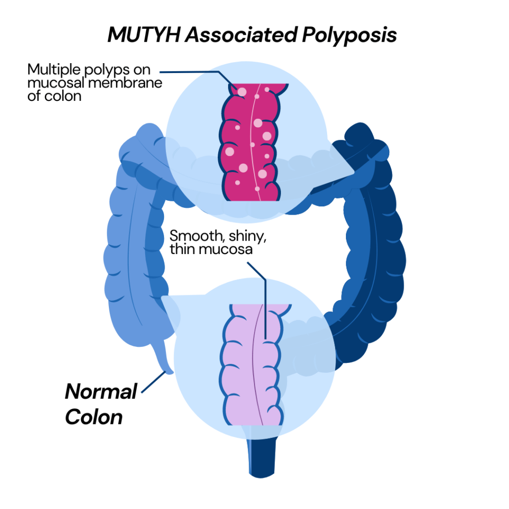 mutyh associated polyposis: Pictographic showing the difference between the normal colon which is smooth, shiny and with thin mucosal membrane and multiple growths like polyps on the mucosal membrane resulting in MUTYH Associated Polyposis