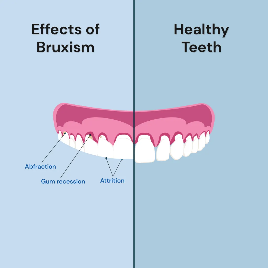 teeth grinding- infographic picturizing the comparison between healthy teeth and the effects of bruxism