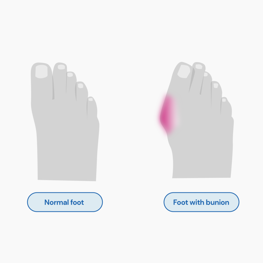 An image comparing normal foot and foot with bunion. The foot with bunion has a protrusion right below the big toe.