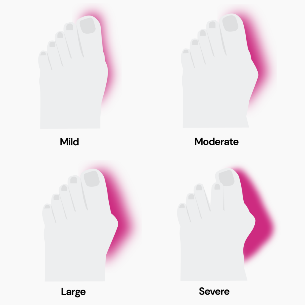 An image depicting 4 progressing levels of severity of bunions. 