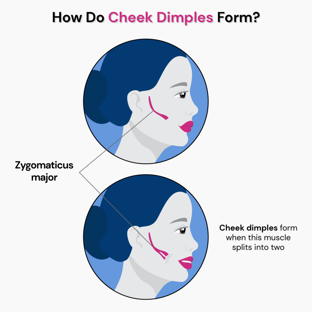 The zygomaticus major muscle that extends from cheekbone to near the mouth, splits into two in some people, resulting in the formation of dimples when smiling.